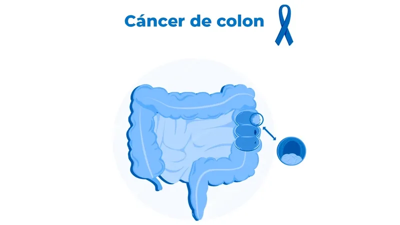 Cómo prevenir el cáncer de colon: guía completa